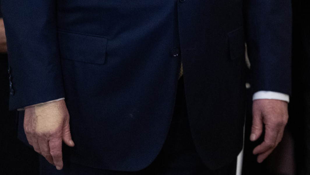 Ce este insuficiența venoasă cronică, boala de care suferă Donald Trump. Medic: „Ridică un semnal de alarmă despre problemele de fond”